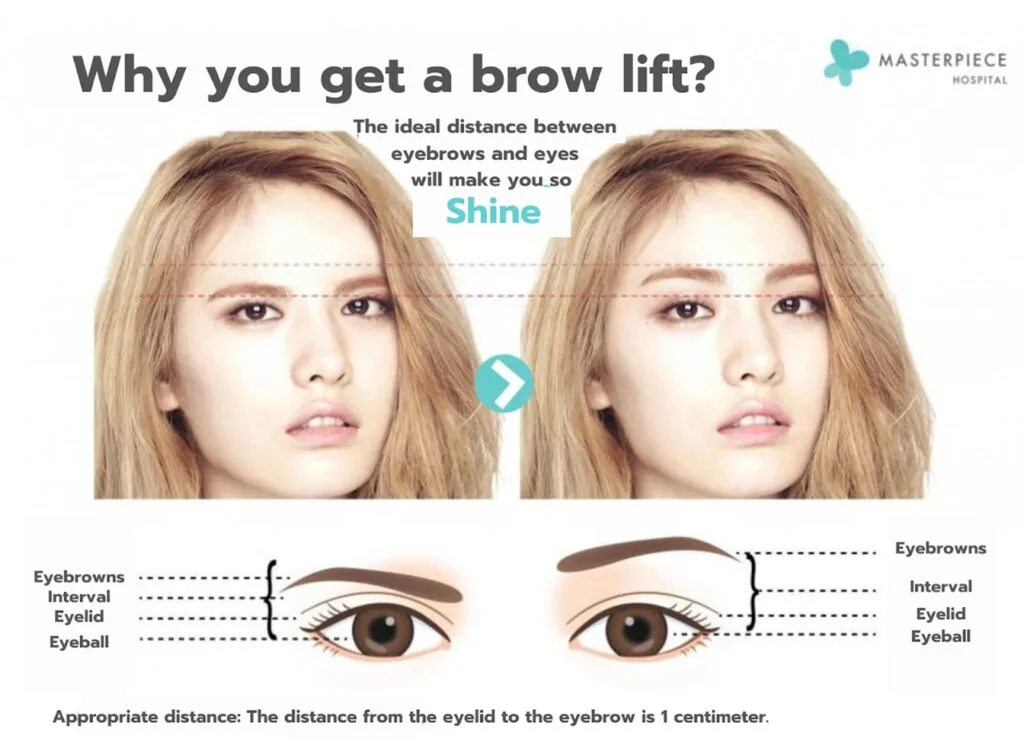 Apa itu bedah pengencangan wajah?