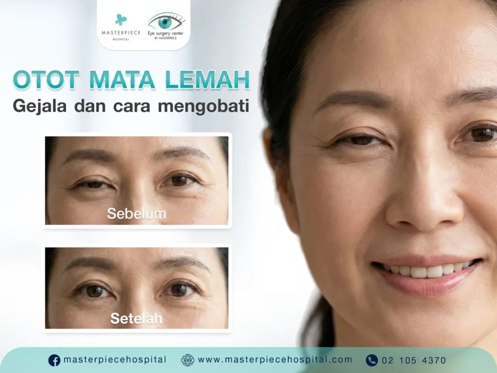 Mengatasi Masalah Otot Kelopak Mata Lemah