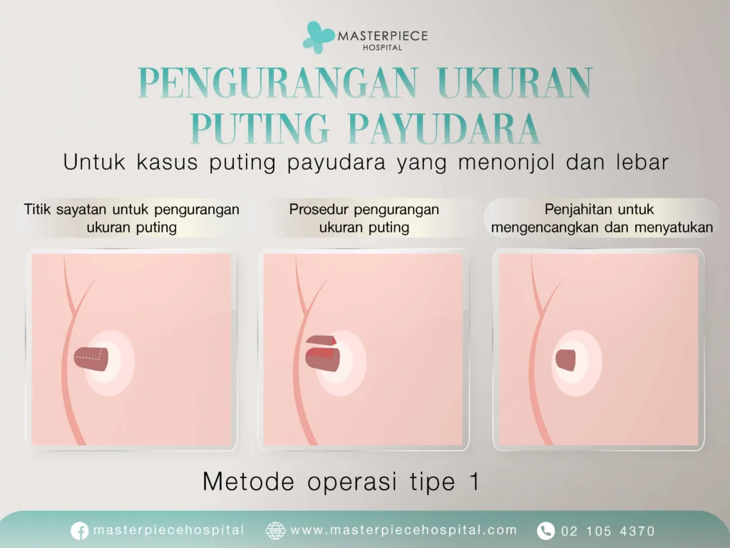 Alasan Melakukan Operasi Pengurangan Ukuran Puting