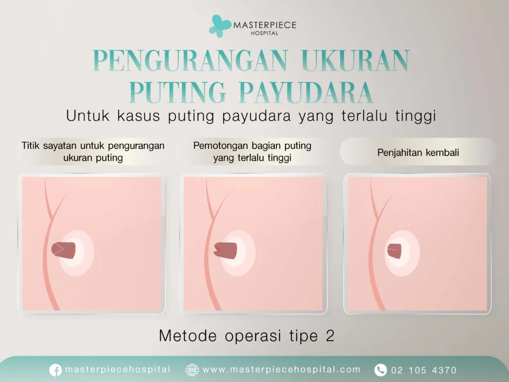 Alasan Melakukan Operasi Pengurangan Ukuran Puting