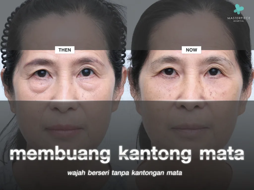Apa Saja Cara untuk Membuat Area Bawah Mata Tampak Cerah dan Muda Kembali