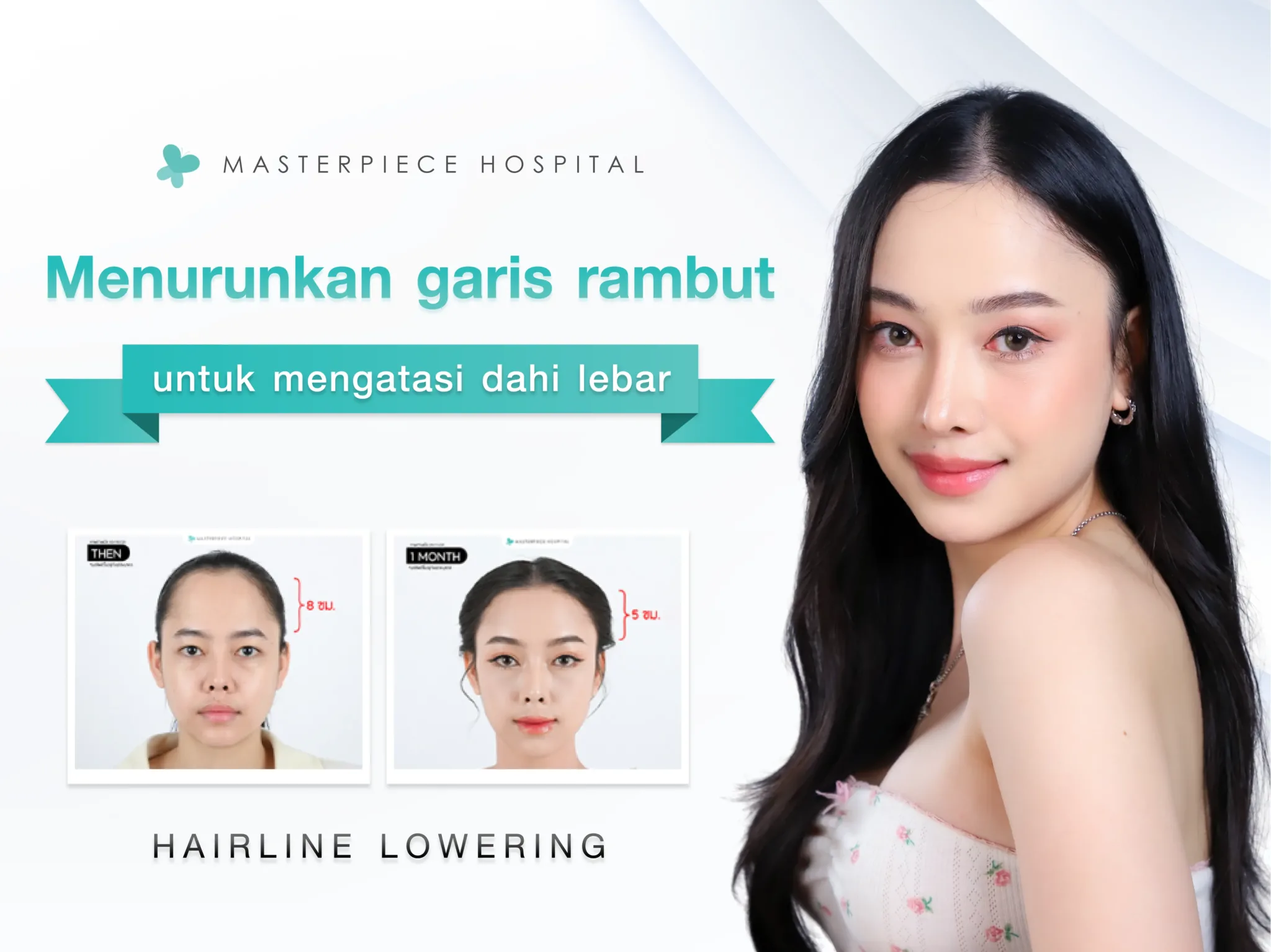 Menggeser Garis Rambut dan Mengecilkan Dahi: Solusi untuk Dahi Lebar