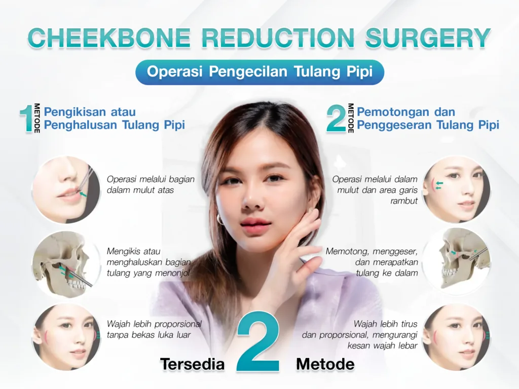 OPERASI PENGURANGAN TULANG PIPI