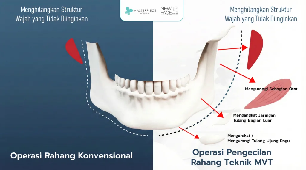 Operasi Pengecilan Rahang Teknik MVT