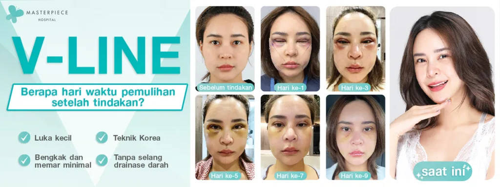 Berapa Lama Pemulihan Operasi V Line 3 Titik?