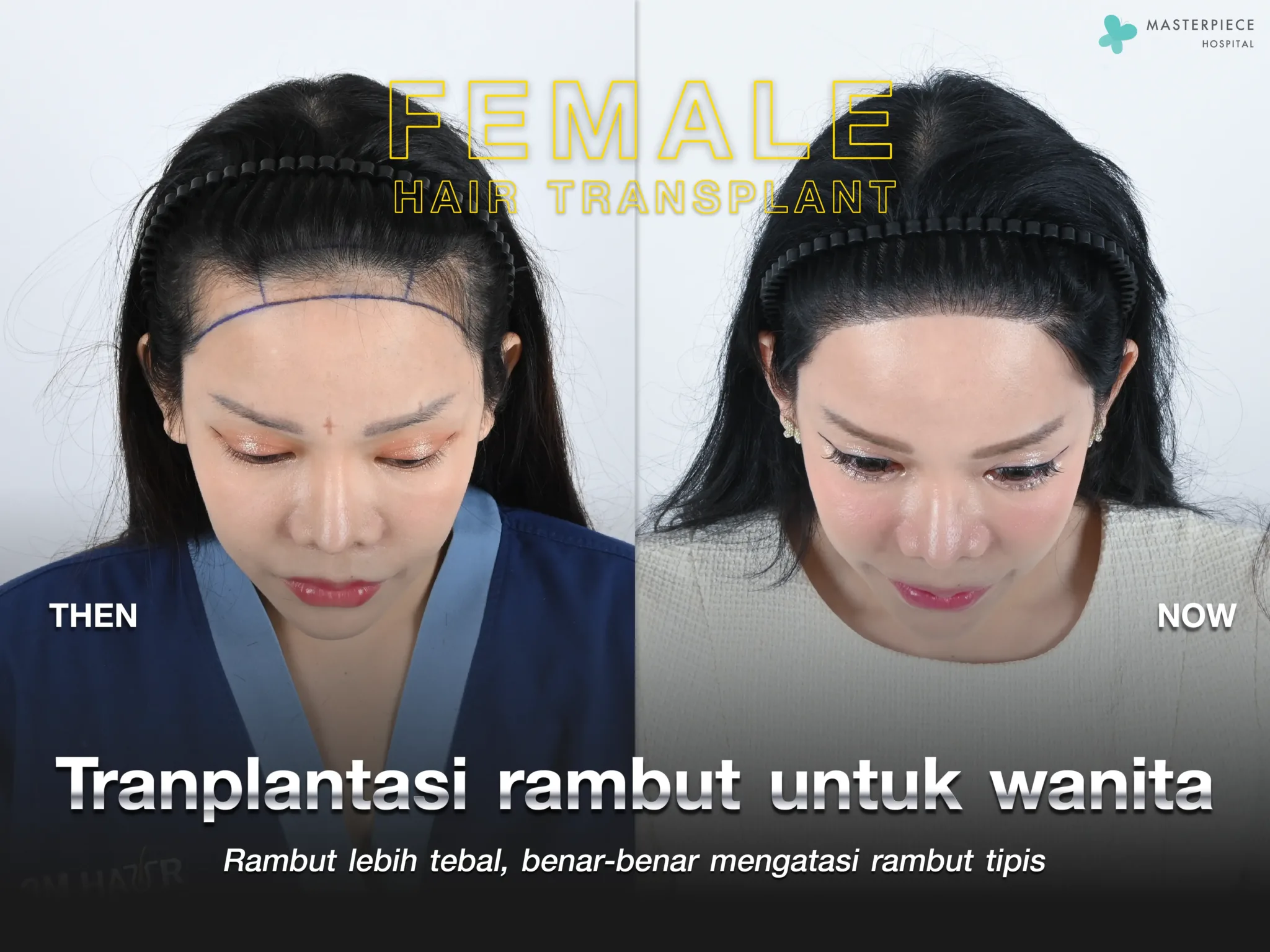 Transplantasi Rambut Wanita, Rambut Lebih Tebal Secara Nyata, Solusi Masalah Rambut Menipis