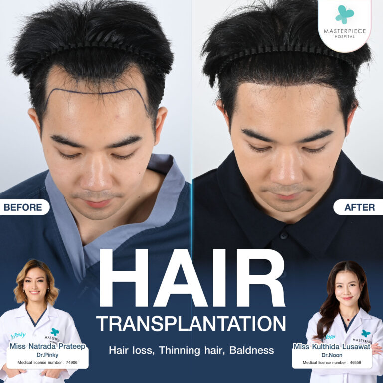 Transplantasi rambut di Rumah Sakit Masterpiece menggunakan teknik FUE dan DHI dengan ulasan asli.