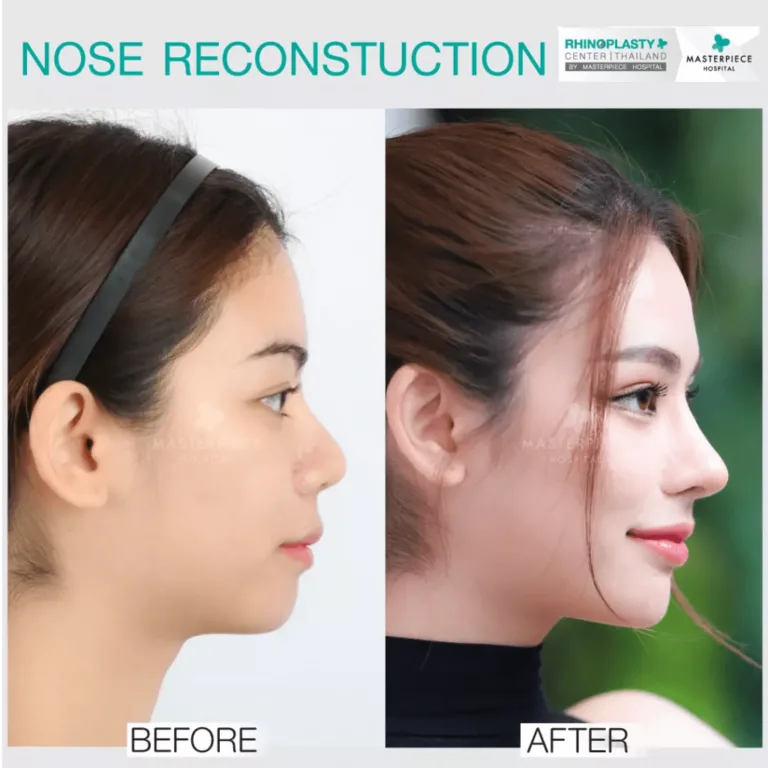 Apakah pembesaran hidung berbahaya?