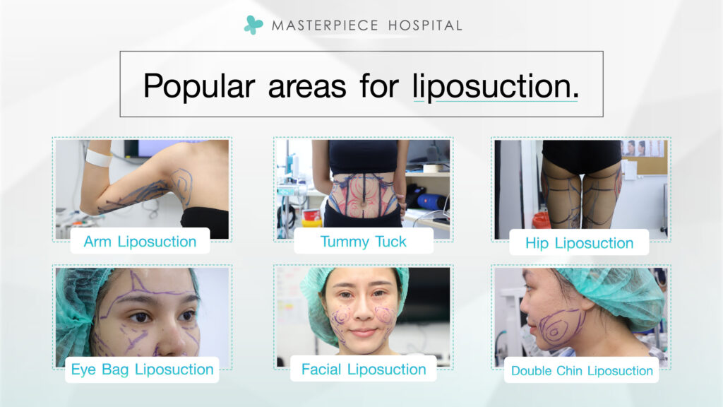Pilih topik yang Anda inginkan. Semua tentang sedot lemak